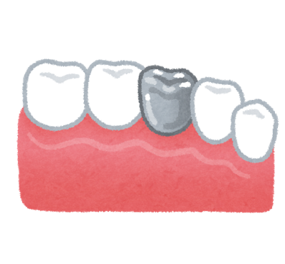 日本で一般的な銀歯（パラジウム合金）は多くの問題がある上に危険！？金属アレルギーや内部の虫歯、歯周病の恐れを現役歯科医が指摘！